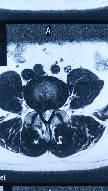 38岁右侧腰腿痛10月，无法正常生活工作。微创手术治疗