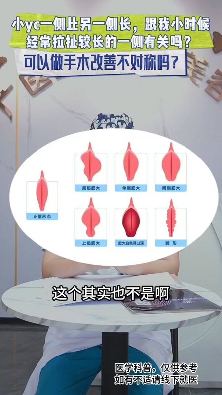 女性小阴唇一侧长是因为经常拉扯的原因吗？这种不对称做手术可以矫正吗？