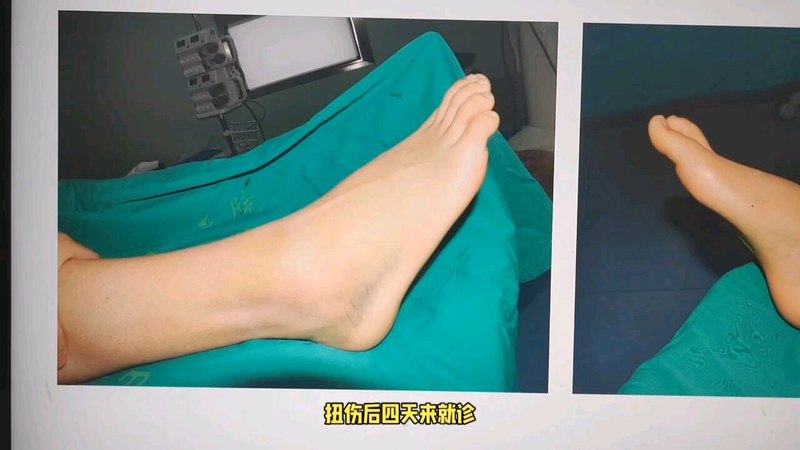 距腓前韧带腓骨止点撕脱骨折病例分享