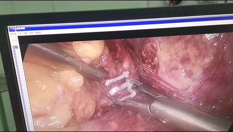 右侧肾上腺腺瘤并发高血压患者的微创手术。我们通过微创手术治疗一部分继发性高血压。