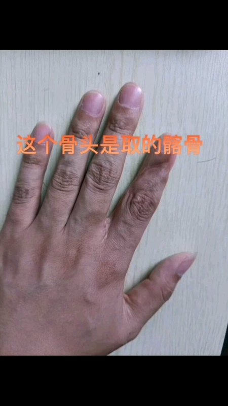 三度以内手指再造到底是怎么做的？