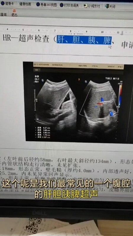 胆囊壁增厚啥意思？