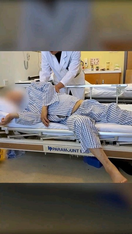 88岁老人家脊髓型颈椎病，微创术后短期随访结果。老人家后悔来的太晚了。