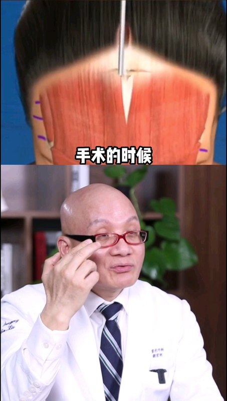 内窥镜额部除皱原理