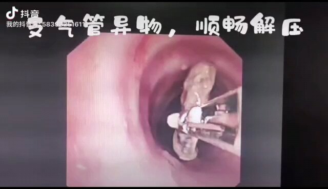 气管异物取出术