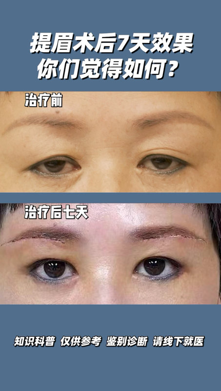 提眉术后七天，你们觉得如何，目光如炬！