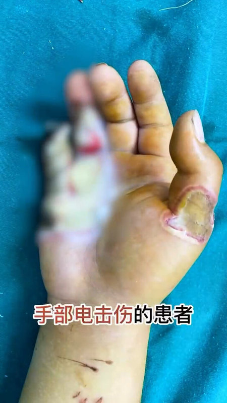 手部电击伤，皮瓣修复，保指成功，外观功能恢复好