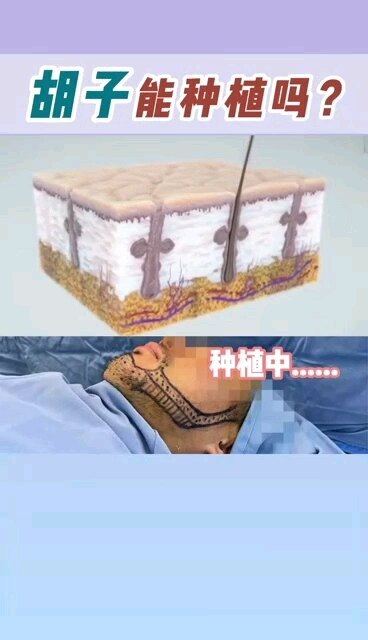 胡须种植演示视频