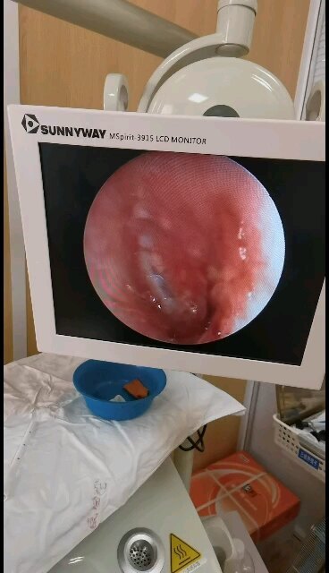 耳内镜微创术后2周，第一次复查，鼓膜穿孔已愈合，耳道内切口已愈合