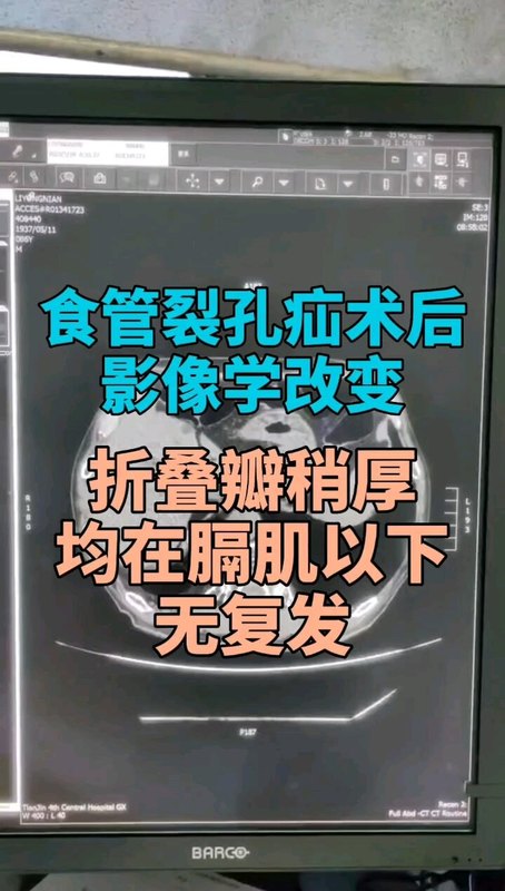 食管裂孔疝术后无法杜绝复发