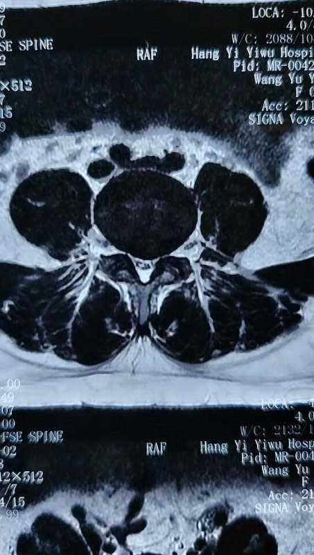27岁腰腿痛，微创手术义乌医院