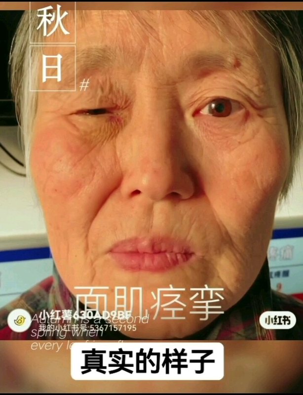 面肌痉挛与梅杰综合征病因不同，面肌痉挛是单侧眼睛与嘴巴同时抽动，梅杰综合征则是双眼同时抽动