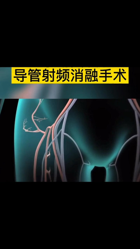 什么是射频消融手术？