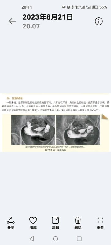 盆腔粘连的子宫输卵管造影表现
