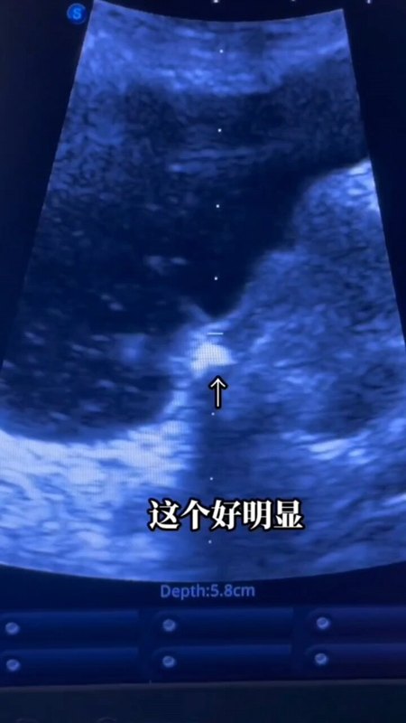 带你看下什么体外冲击波碎石是怎么回事