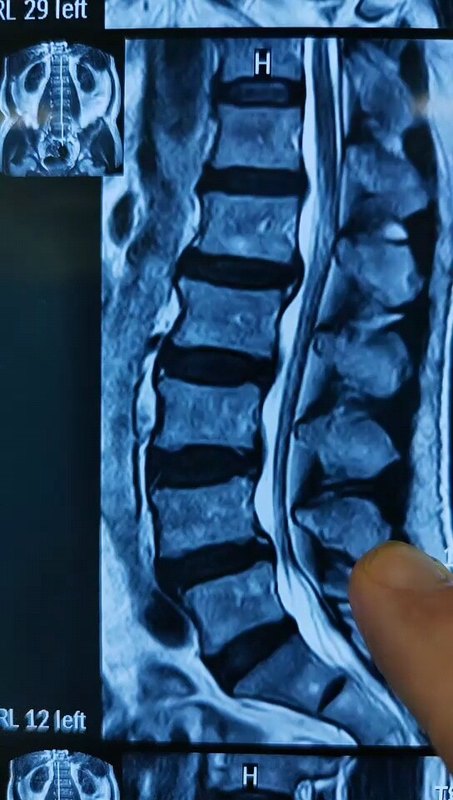 67岁腰椎管狭窄腰椎滑脱，微创手术