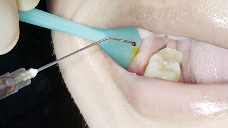 智齿伤口冲洗示范