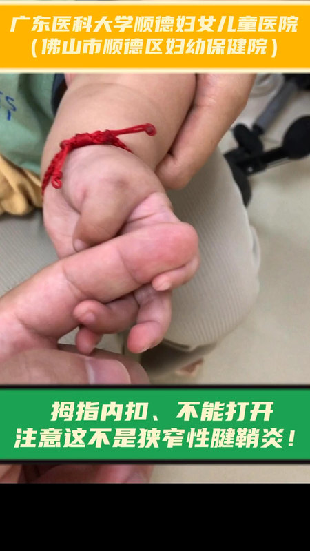 拇指内扣、不能打开，注意这不是狭窄性腱鞘炎！