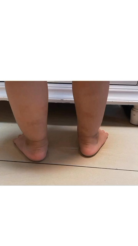 女儿两岁了，扁平足，足跟外翻，第四趾侧弯，小趾屈曲外翻，这些情况在两岁时的宝宝很常见，大部分不需要特