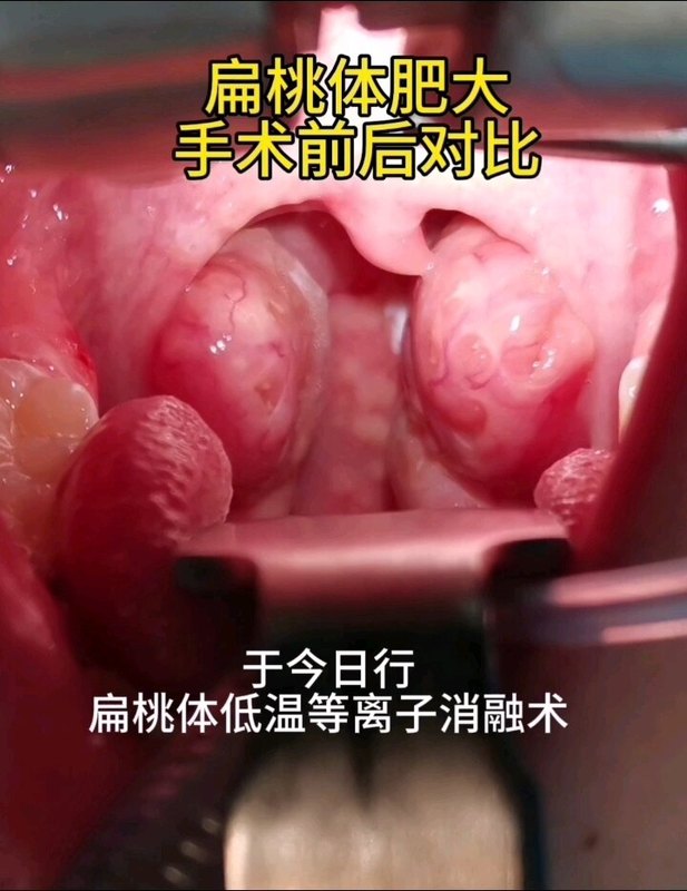扁桃体肥大，低温等离子消融术，做到极致就是看不到创面！