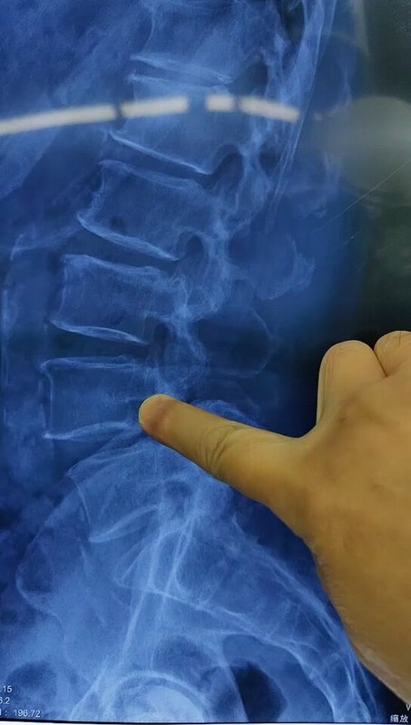 今天八台手术，70退行性滑脱狭窄，微创手术