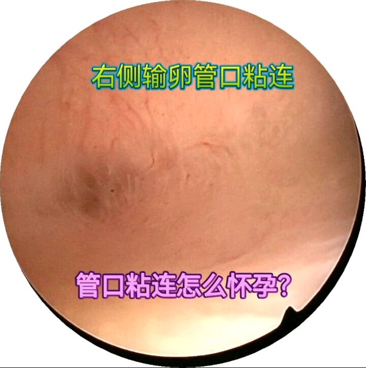 备孕，输卵管不通怎么办？
