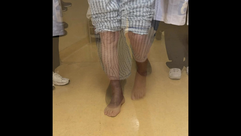 脊髓损伤后痉挛性马蹄足剪刀步显微外科术前术后走路视频