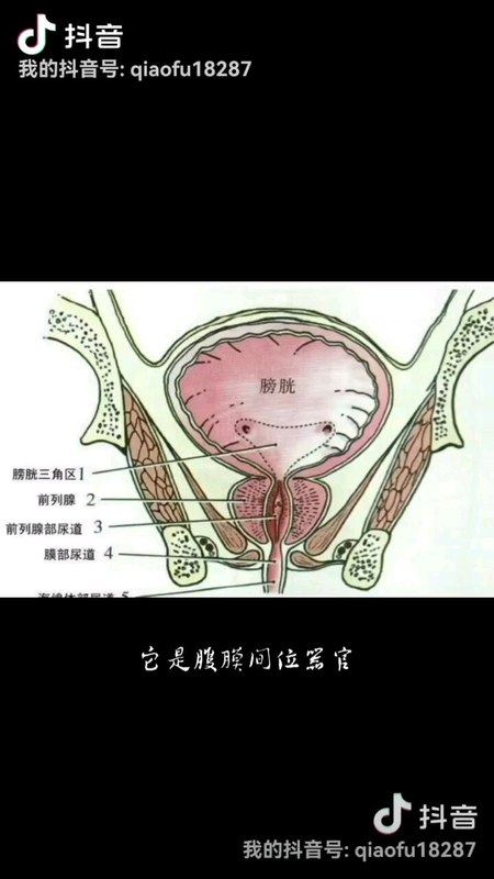 一种少见而又具体潜在风险的腹股沟疝——膀胱疝