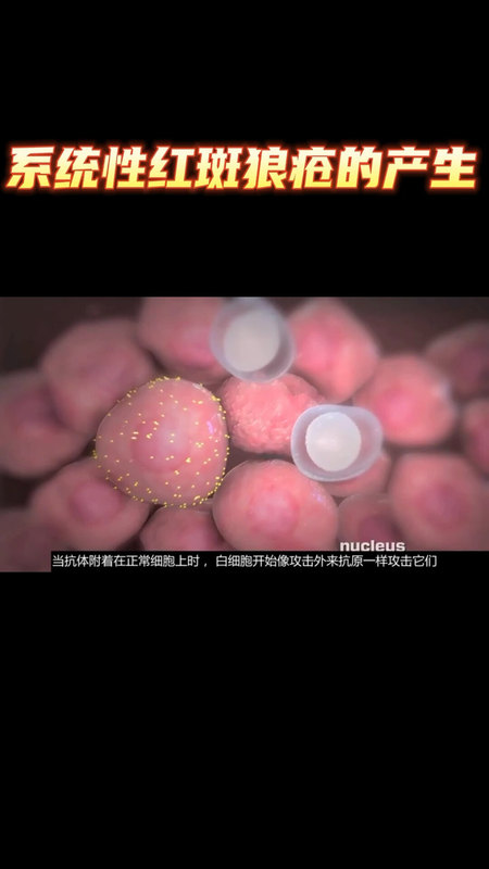 系统性红斑狼疮，中西医结合诊治疗效稳定