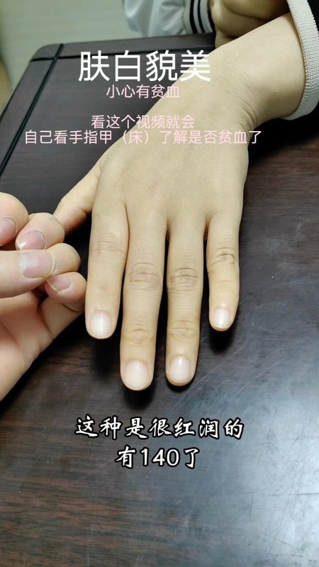 从指甲甲床看贫血
