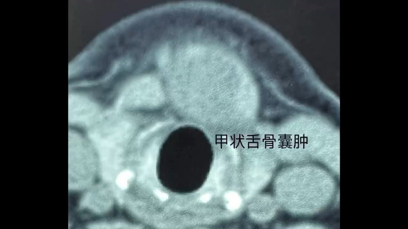 甲状舌骨囊肿，尽早解决手术