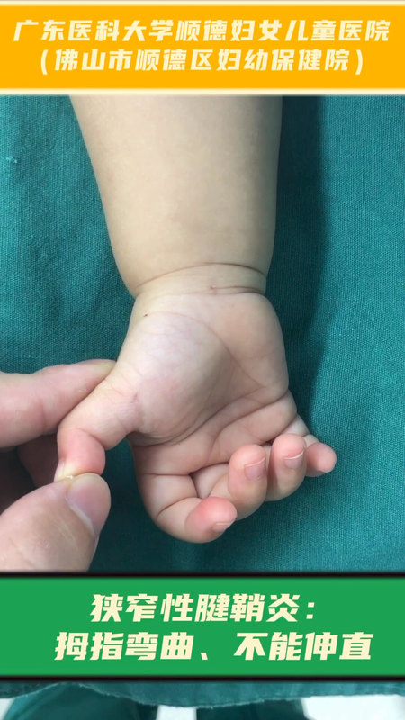 狭窄性腱鞘炎：拇指不能主动伸直，甚至不能被掰直，掌指关节处可摸到凸出硬结。这种情况需要微创手术松解。