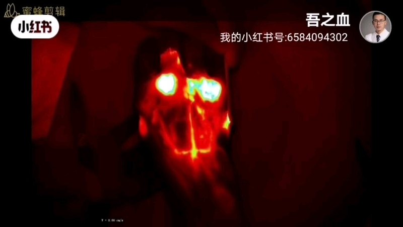 淋巴水肿功能淋巴管之红荧光