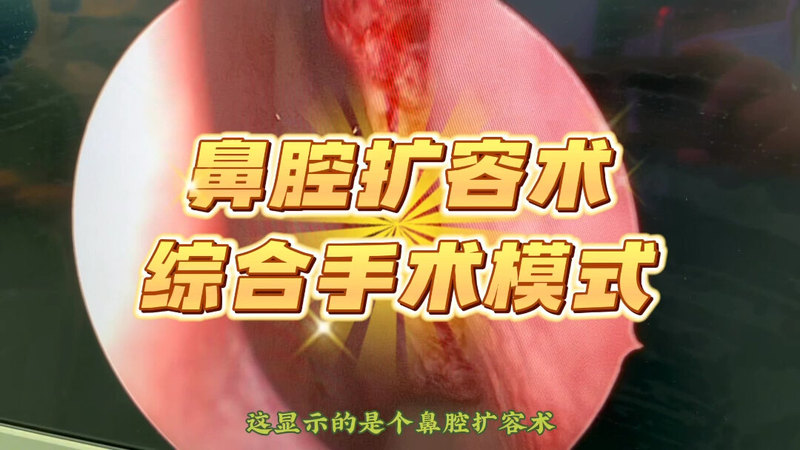 鼻腔扩容术，减轻损伤，综合手术模式
