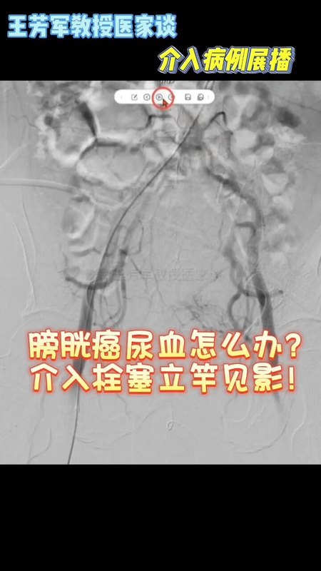 膀胱癌大量尿血怎么办？介入栓塞立竿见影