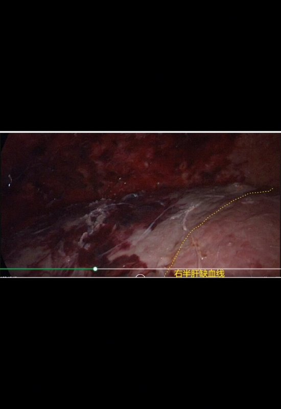 腹腔镜下解剖性右半肝切除