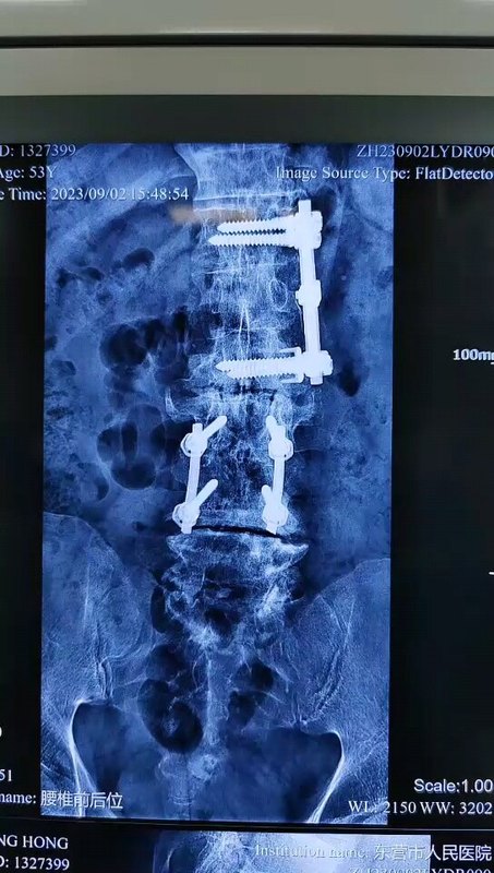 53岁腰腿痛，22年手术病史，16个手术切口，继续微创手术