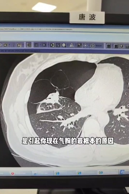 双肺多发肺大疱，I,II,III型都有，手术切除有诱发气胸风险的，其它没有风险也不需要切除。