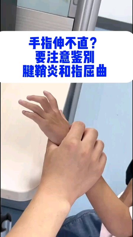 手指伸不直，要注意鉴别腱鞘炎和指屈曲