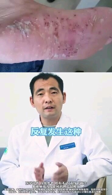手脚上的小水泡你有吗