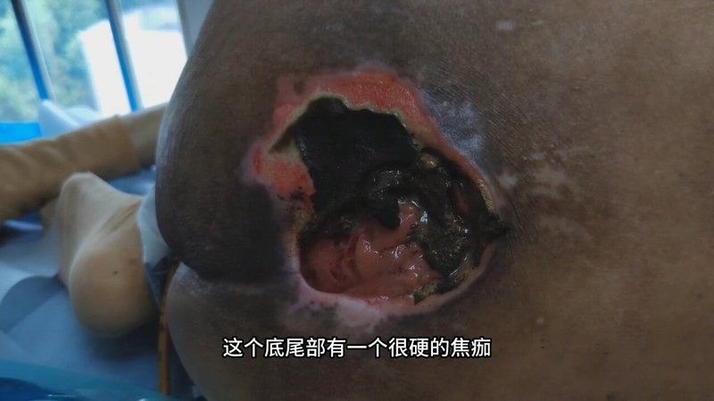 褥疮，黑痂或黄色，随访换药，看着这个就足够了！