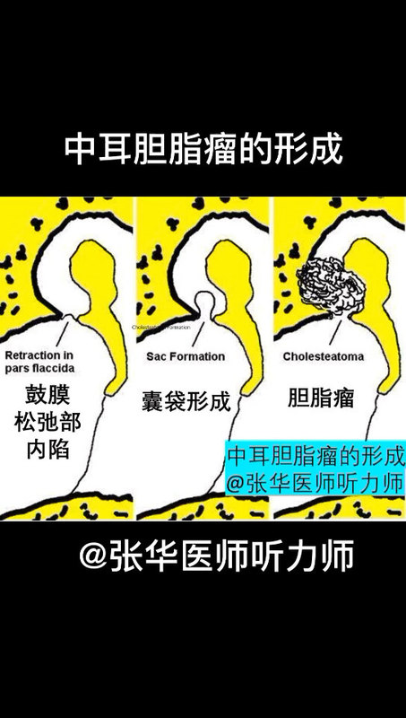 中耳胆脂瘤的形成过程