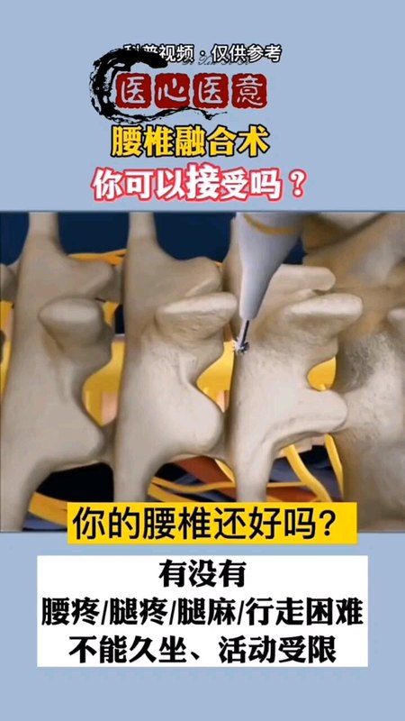腰椎手术视频动画