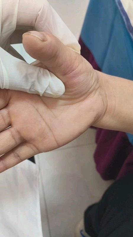 拇指腱鞘炎针刀一分钟治愈
