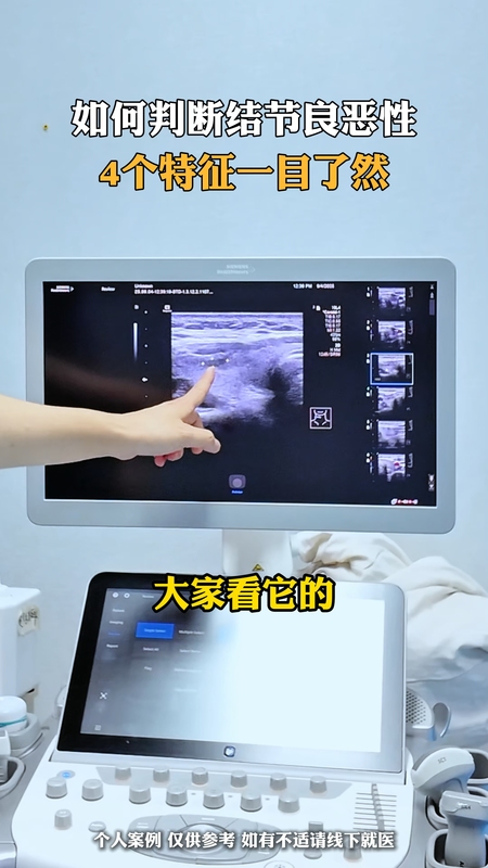 手把手，教你认识甲状腺良性结节