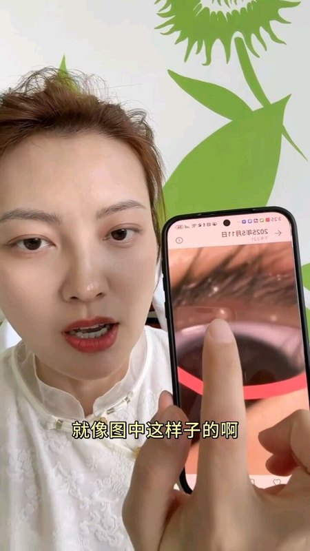 睑缘长了小白点是什么东西？怎么处理？