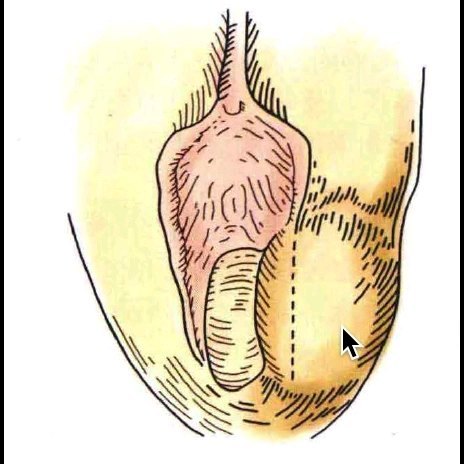 前庭大腺脓肿是什么