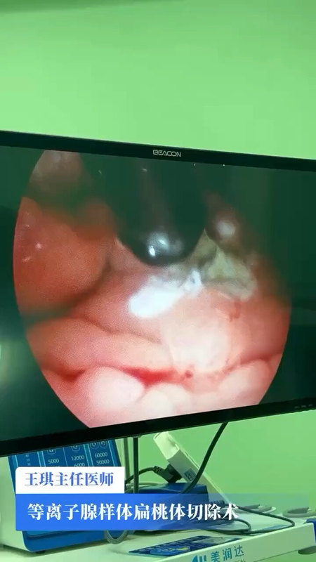 腺样体扁桃体切除术后，呼吸状况改善立竿见影