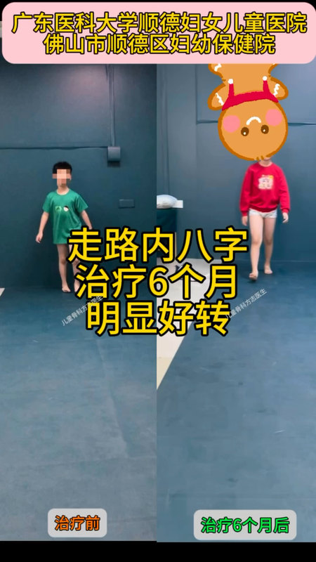走路内八字，治疗6个月，明显好转。