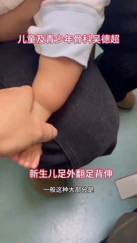 新生儿及小婴儿足外翻足背伸＃儿童骨科 ＃医生日常 ＃门诊故事 ＃足外翻 ＃新生儿脚丫